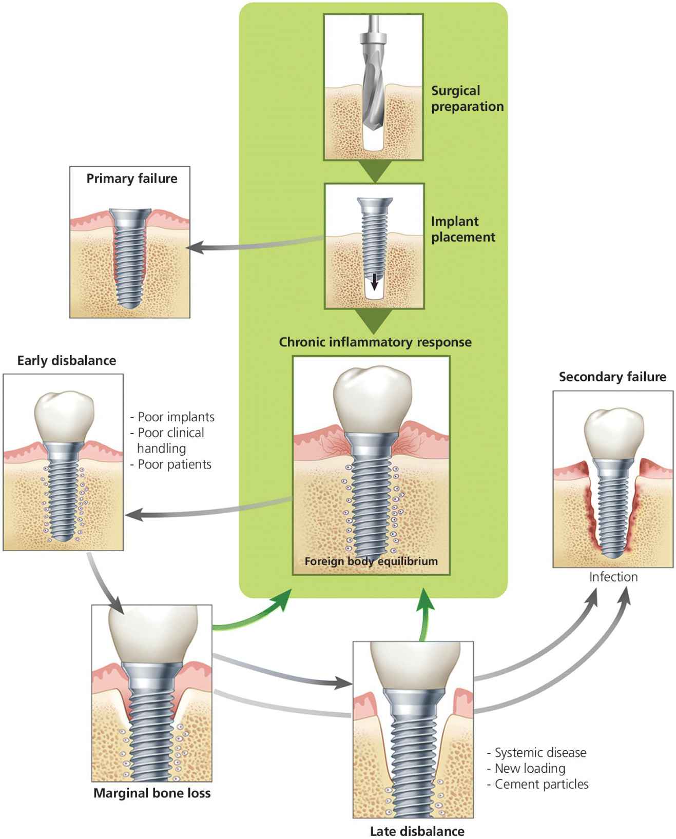 Process diagram of the foreign body equilibrium reaction illustrating flow from surgical preparation to implant placement depicting primary failure resulting in marginal bone loss and secondary failure.