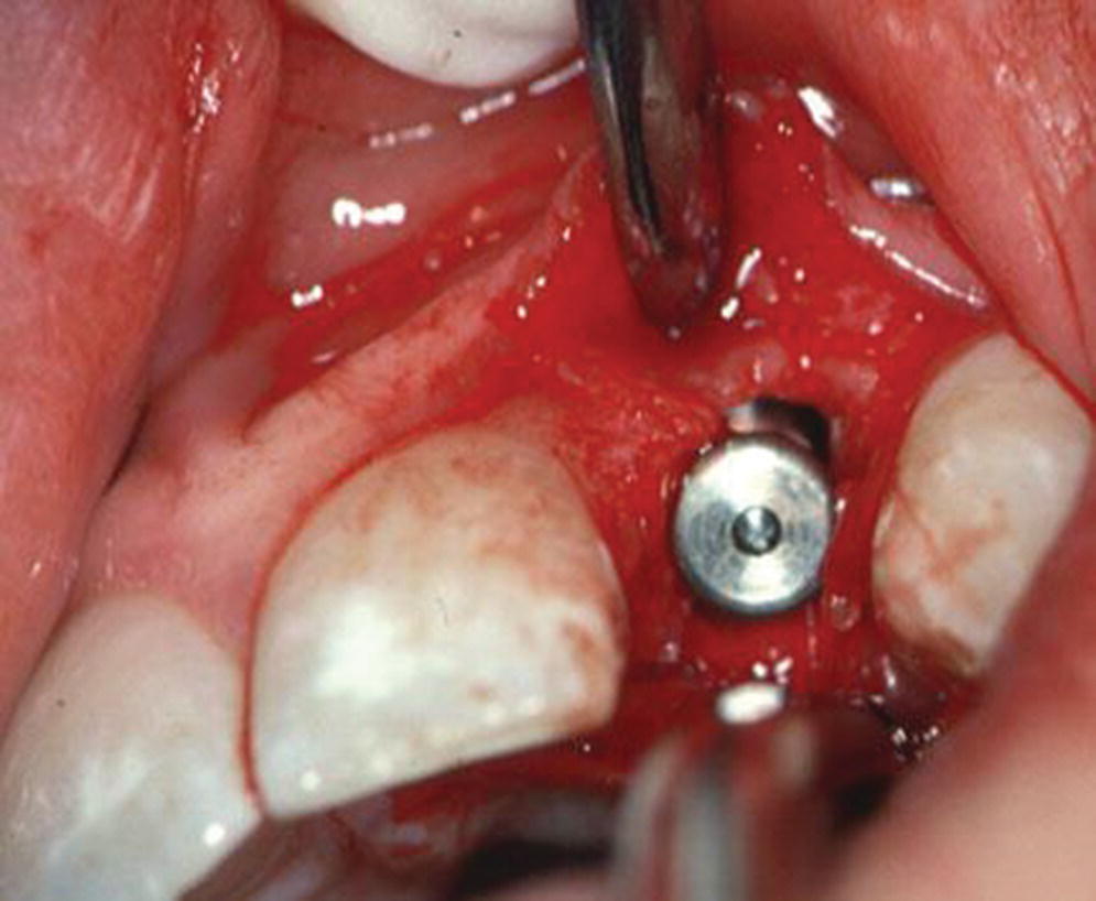 Photo displaying the placement of implant in horizontal plane with ≥2 mm bone facial to fixture.