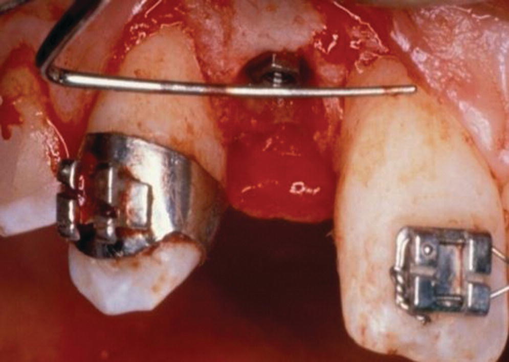 Photo displaying the placement of implant in frontal plane 2–3 mm apical to the adjacent teeth cementoenamel junction.