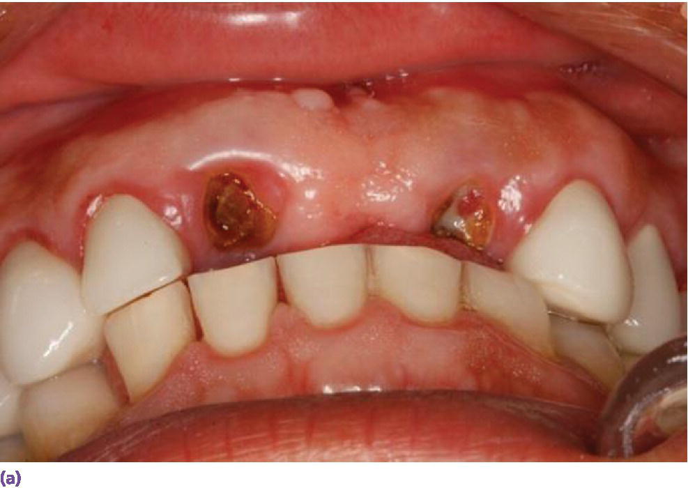 Photo displaying facial view of class II, division 2 jaw relation pre?empting replacement of decoronated roots with a screw-retained implant fixed dental prosthesis due to lack of space for screw?access housing.