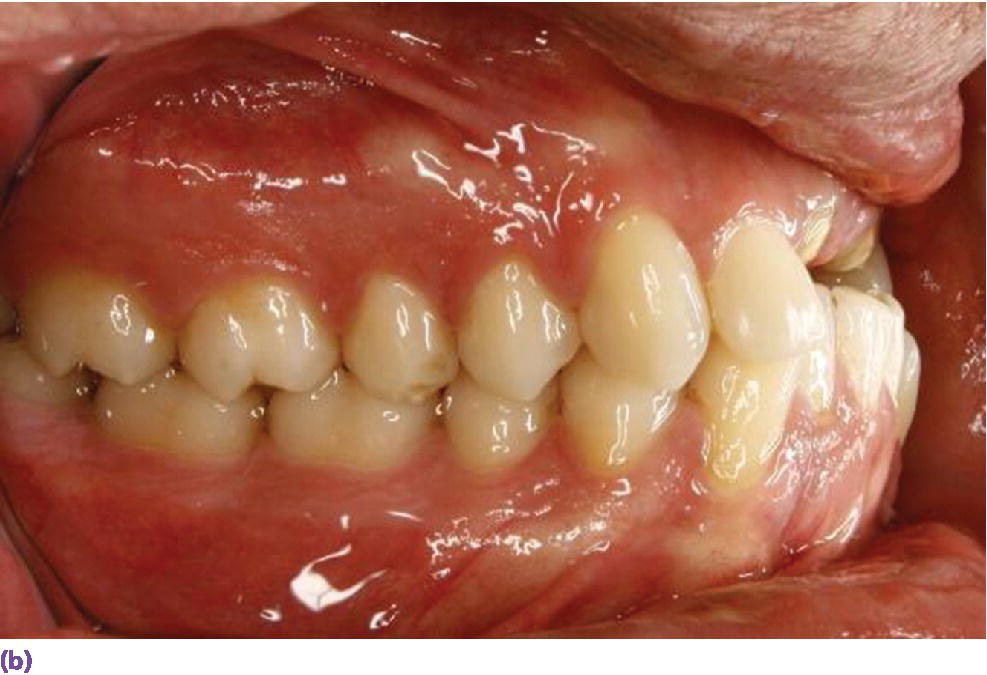 Photo displaying supraeruption of mandibular incisors encroaching on restorative space for implant prosthesis.