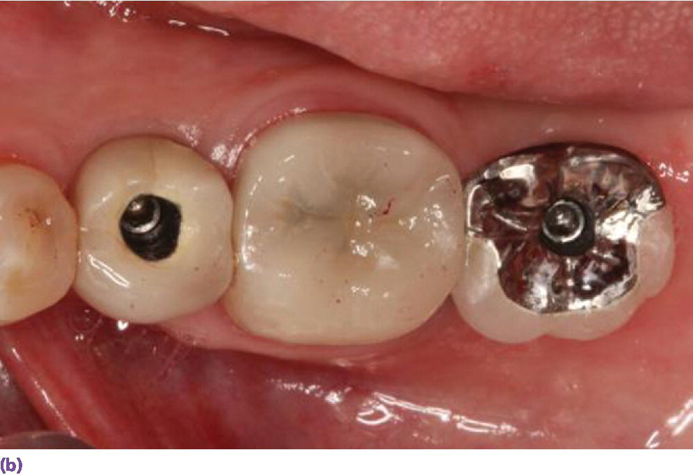 Photo displaying top view representation for screw-retained restorations (top right) using the required minimum of 5 mm interocclusal space.