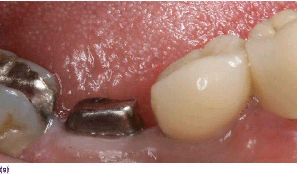 Photo displaying an implant not placed orthogonally with occlusal plane obviating the use of screw?retained design.
