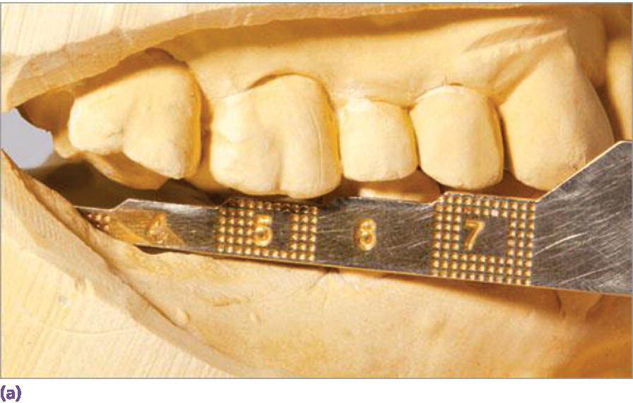 Photo of jaw model illustrating the measurement of vertical space to assess interarch accommodation for screw- or cement-retained restorations.