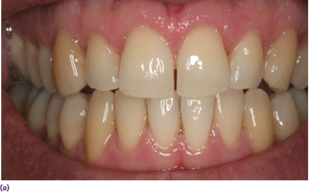 Photo of facial view of teeth displaying thick gingival biotype, square tooth morphology, wide band of attached tissue, and short papillae.