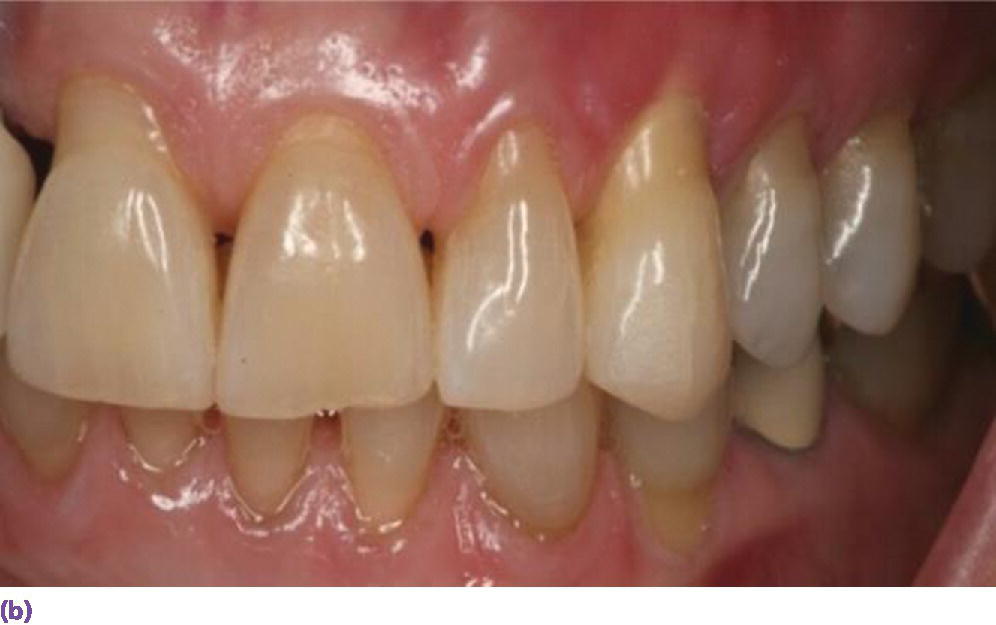 Photo of front-to-left view of teeth displaying thin gingival biotype, trigonal tooth morphology, narrow band of attached tissue, and long papillae.