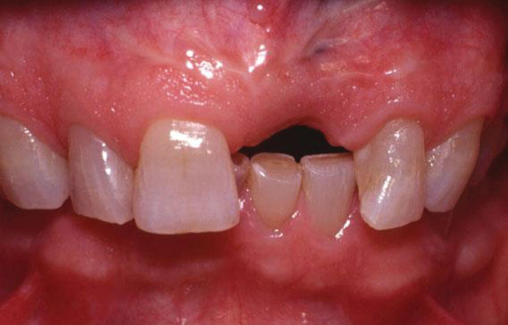 Photo displaying extraction of central incisor on thin biotype without ridge-preservation procedure.