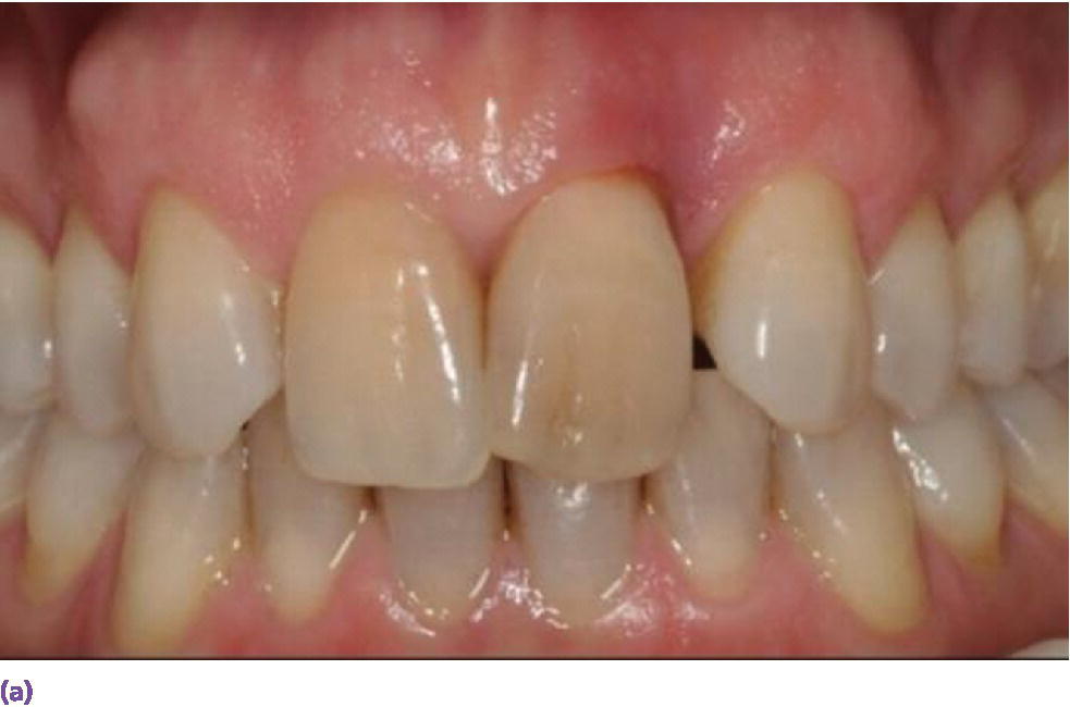 Photo displaying an unrestorable maxillary left central incisor.