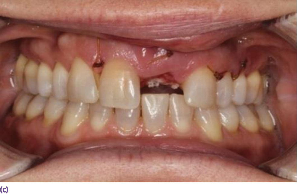 Photo of facial view of teeth displaying subepithelial connective tissue graft in conjunction with implant placement.