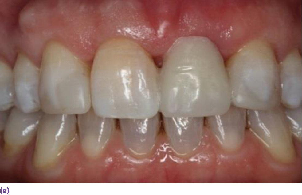 Photo of facial view of teeth displaying the resin-bonded bridge.