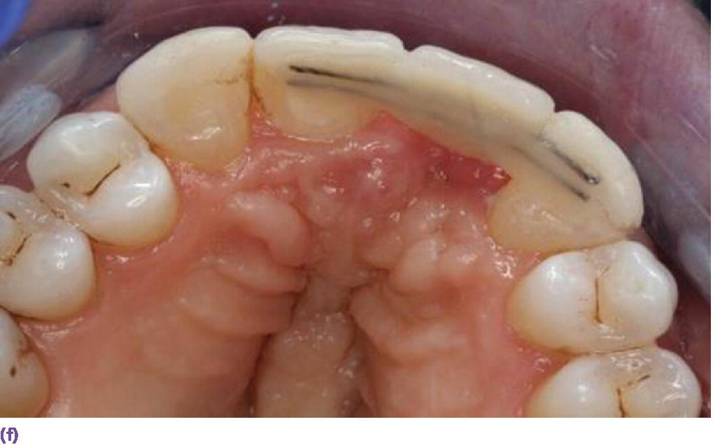Photo of palatal view displaying resin-bonded bridge reinforced with orthodontic braided wire.