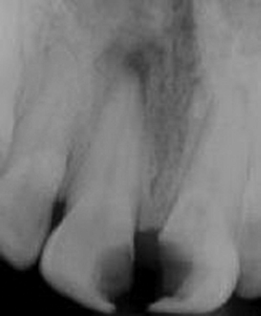 Radiograph of teeth after primary endodontic treatment.