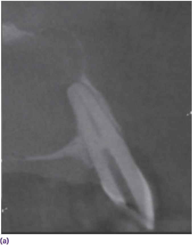 Radiograph of Accuitomo scan of calcified canal of #10.