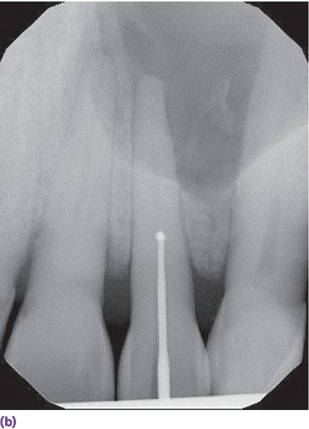 Radiograph of Gates–Glidden drill on the  tooth displaying calcified blockage.