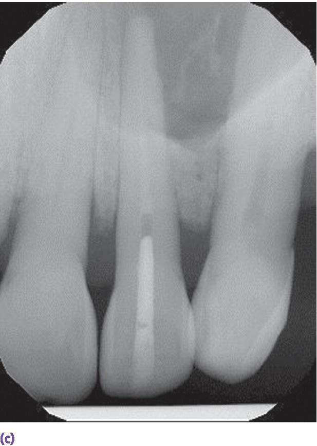 Radiograph of teeth presenting completed obturation of the implant on site #10.