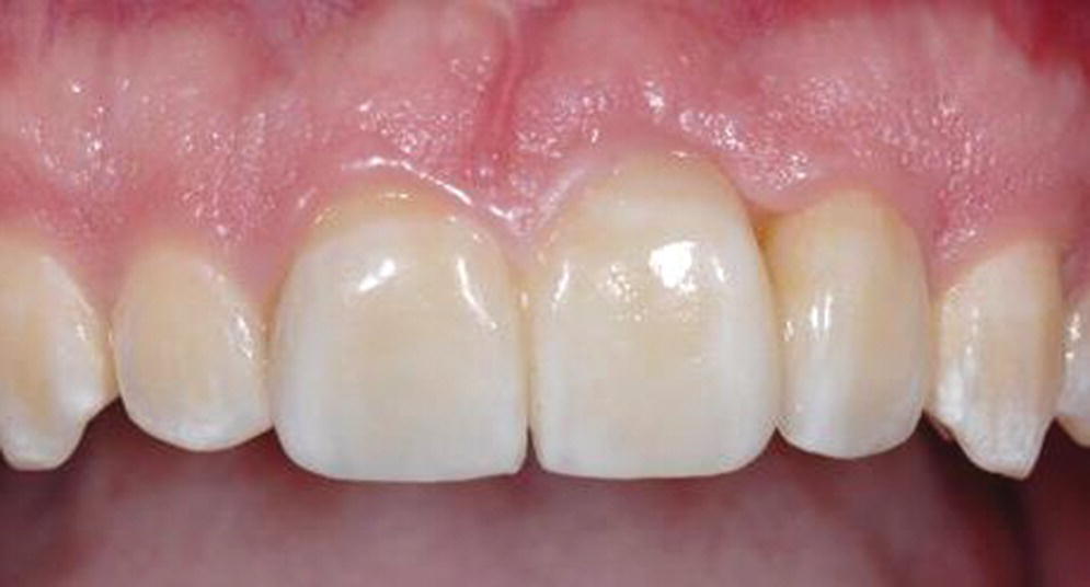 Photo of maxillary teeth depicting a three-unit fixed dental prosthesis replacing left maxillary central incisor teeth.