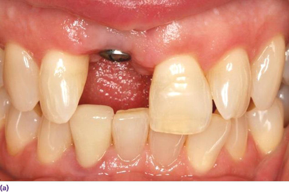 Photo of maxillary and mandibular teeth from front view depicting an abutment positioned between left maxillary lateral incisor and right maxillary central incisor teeth.