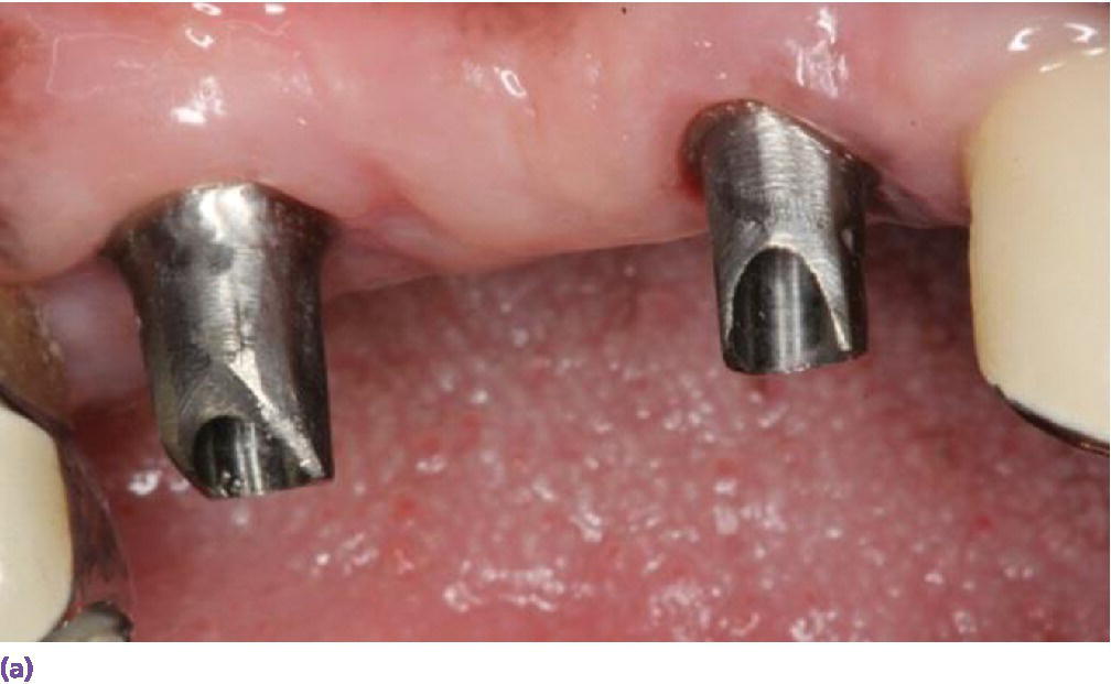 Photo of gum and two titanium abutments (placed two missing teeth apart) on the posterior jaw region.