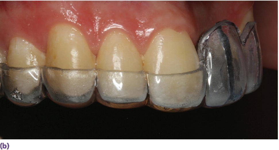 Photo of radiographic guide fabricated using a vacuum template with lead foils centered on each tooth tried intraorally.