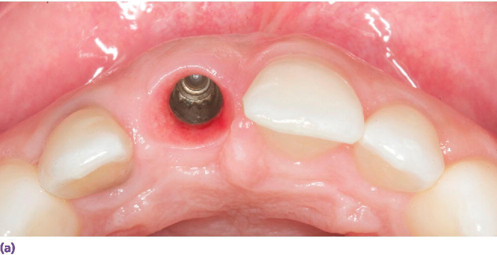 Photo of occlusal view of implant placed at site #8 demonstrating its facial and superficial misplacement.