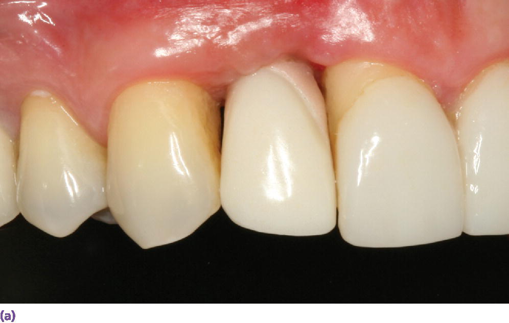 Photo displaying facial view of implant crown at site #7 demonstrating deficient papillae on both the mesial and distal aspects.