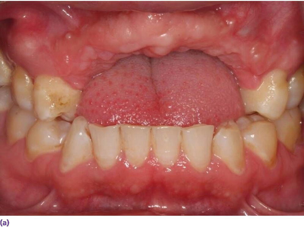 Photo displaying missing maxillary anterior teeth and deficient hard and soft tissues as a result of trauma wherein vertical augmentation would not be predictable.