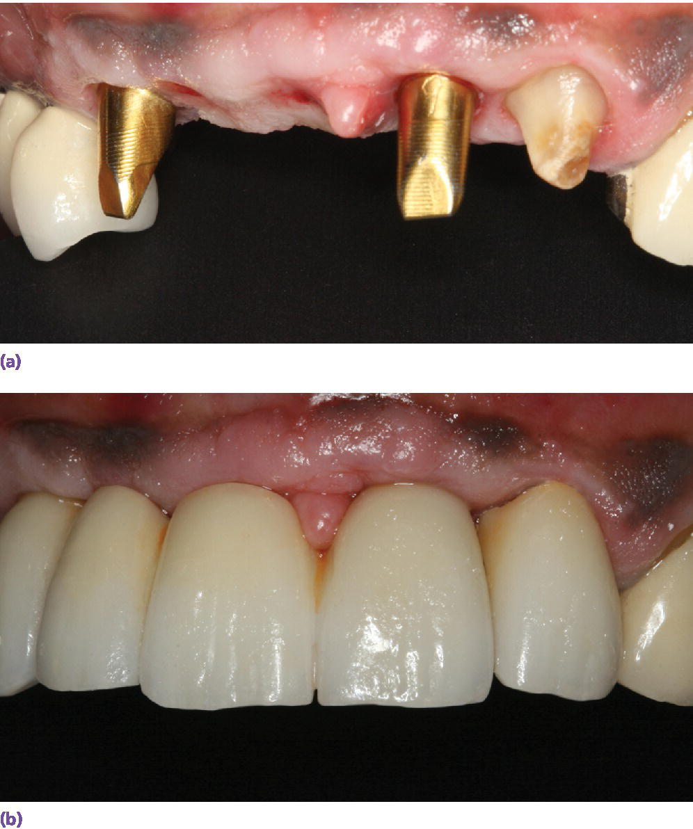 Photo displaying three?unit FDP adjacent to a natural tooth that needs a crown restoration. Custom abutments with gold hue are used to optimize esthetics.