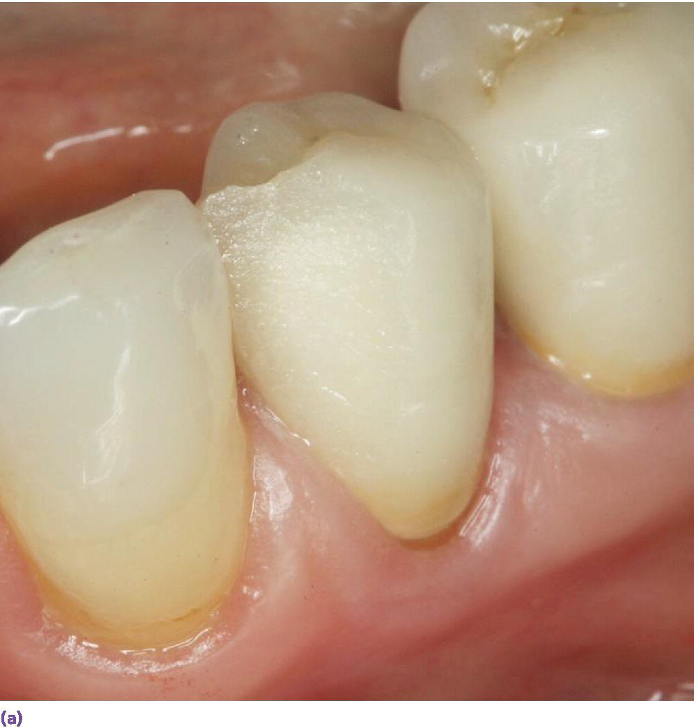 Photo displaying layered zirconia restoration with veneering ceramic fractured