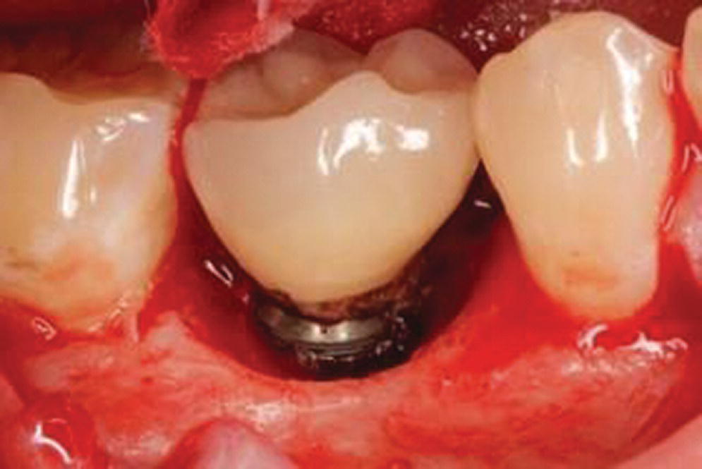 Photo displaying example of implant site with residual excess cement and associated peri-implantitis. The generalized “crater” pattern of bone loss relates to the character of the biological attachment.