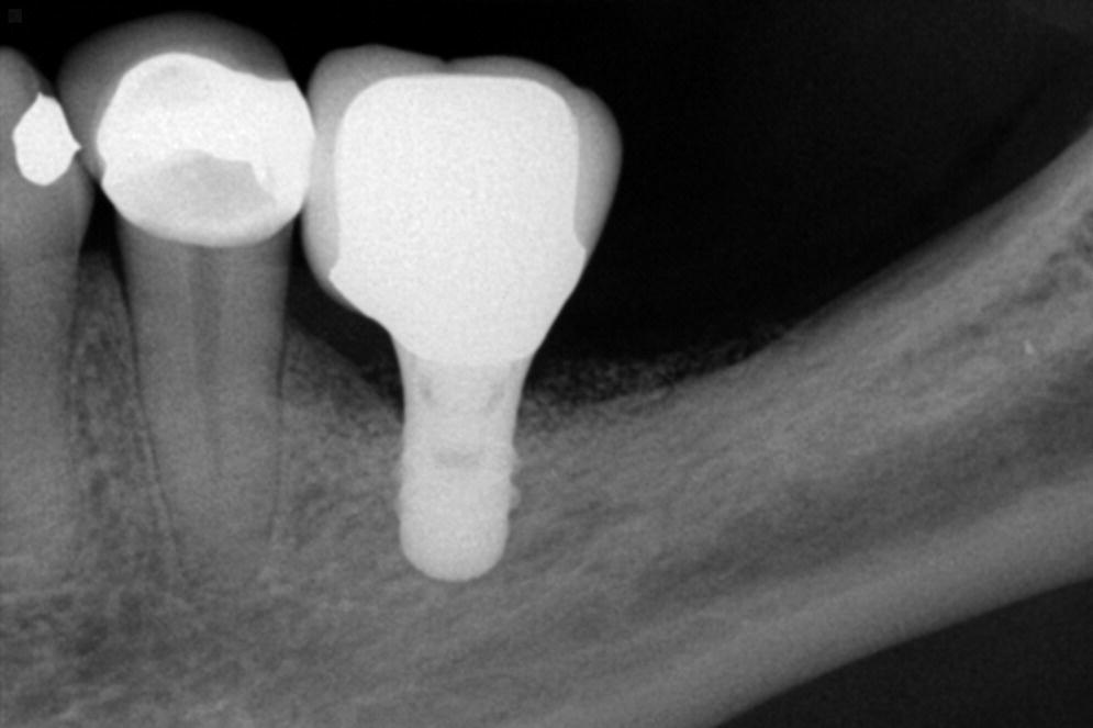 Occlusion in implant dentistry. A review of the literature of