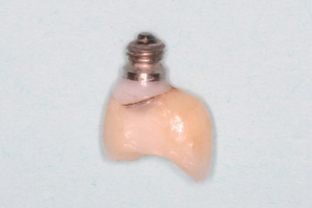 Photo of clinical presentation of a fractured implant which supported a single crown in the maxillary left second premolar region from a bruxism patient.