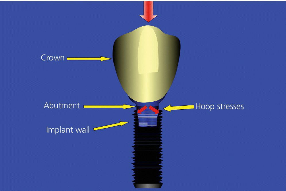 Occlusion in implant dentistry. A review of the literature of