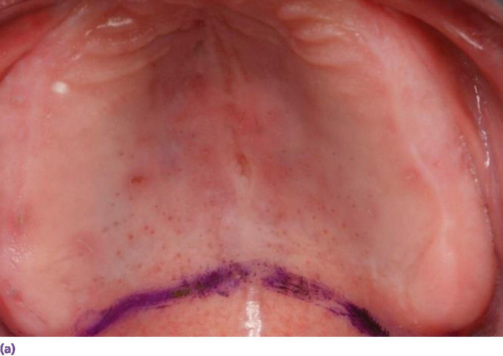 Photo displaying vibrating line between movable and immovable soft palate established with indelible marker.