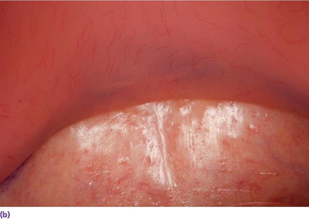 Photo displaying denture in place, demonstrating distal limit engaging the movable soft palate beyond the vibrating line.