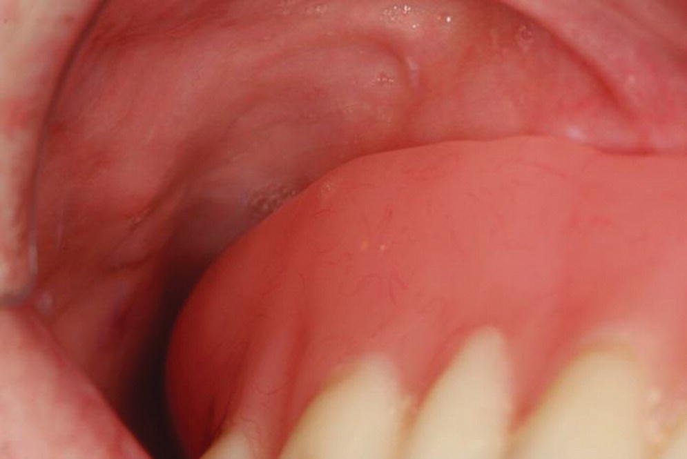 Photo displaying peripheral seal lacking with short flange in the retrozygomatic region.