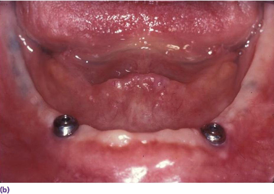 Photo of retruded tongue compromising prognosis of complete denture leading to appropriate implant treatment.