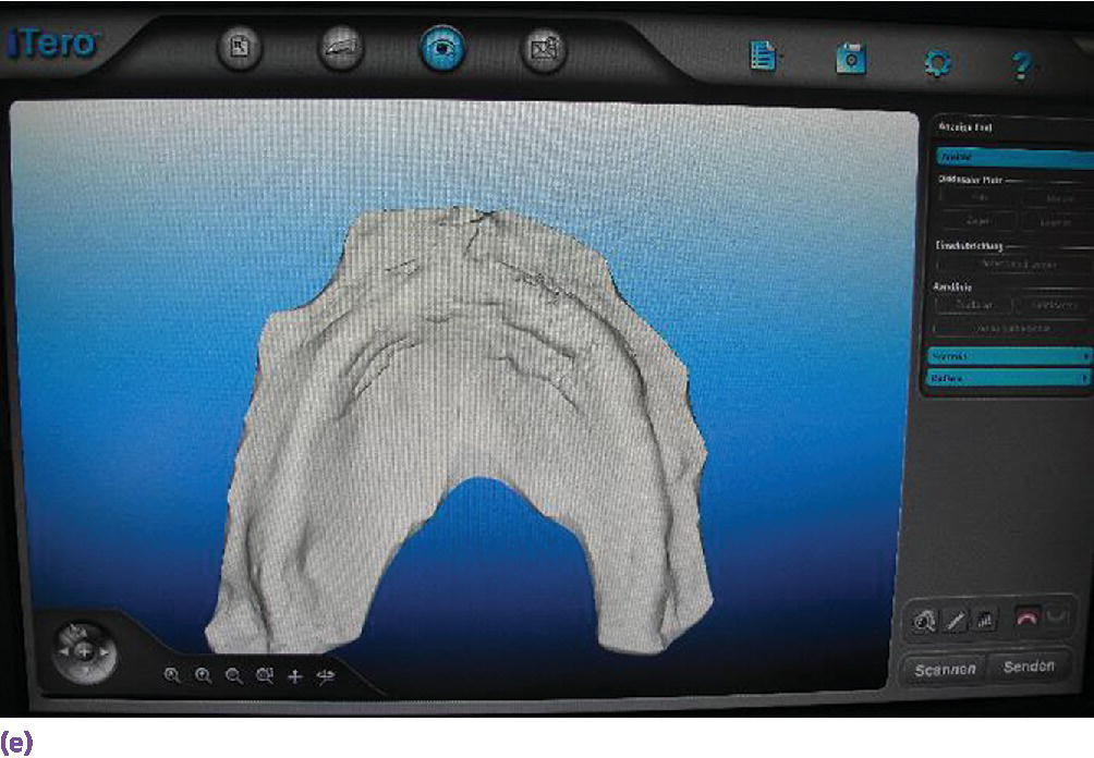 Screenshot displaying 3D intraoral surface scan of the mucosal tissues.