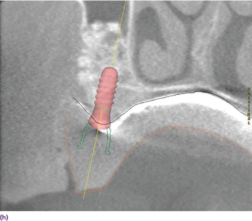 CBCT scan depicting prosthetically-driven implant planning for animplant overdenture with bar retention.