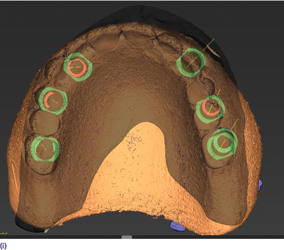 CBCT scan depicting six implants planned in mandible.