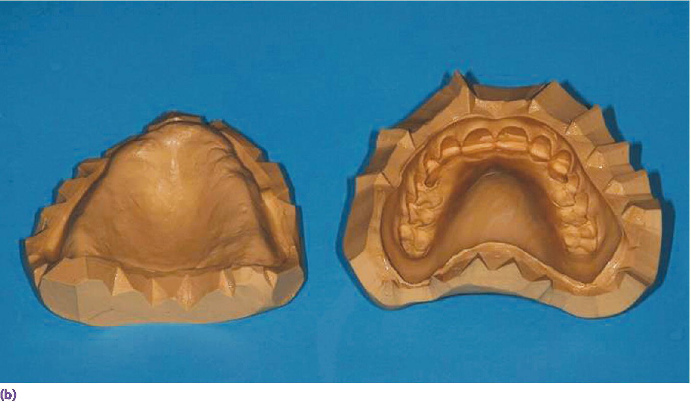 Photo displaying mandibular (left) and maxillary denture (right) used to fabricate a resilient cast.