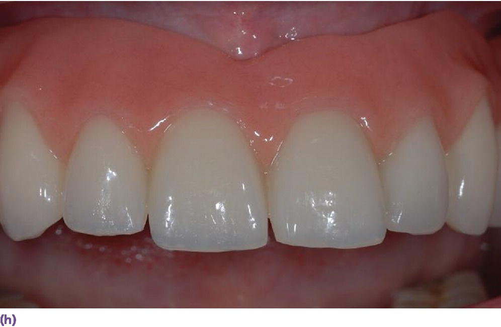 Photo displaying front view of denture with reduced palatal coverage and buccal flange extension.