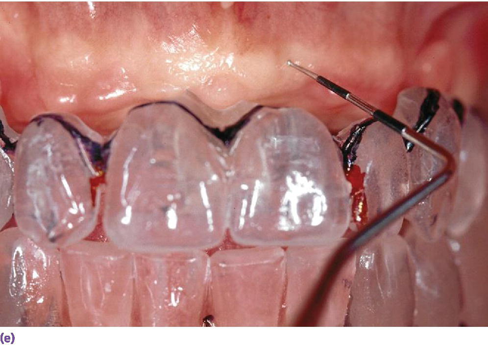 Photo of template try-in illustrating discrepancy between alveolar ridge and diagnostic tooth position in the horizontal dimension.