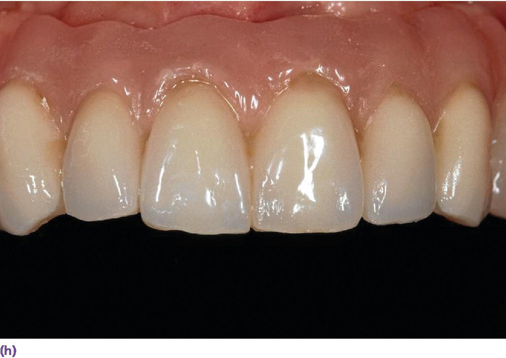 Photo displaying anterior view of teeth with buccal flange.