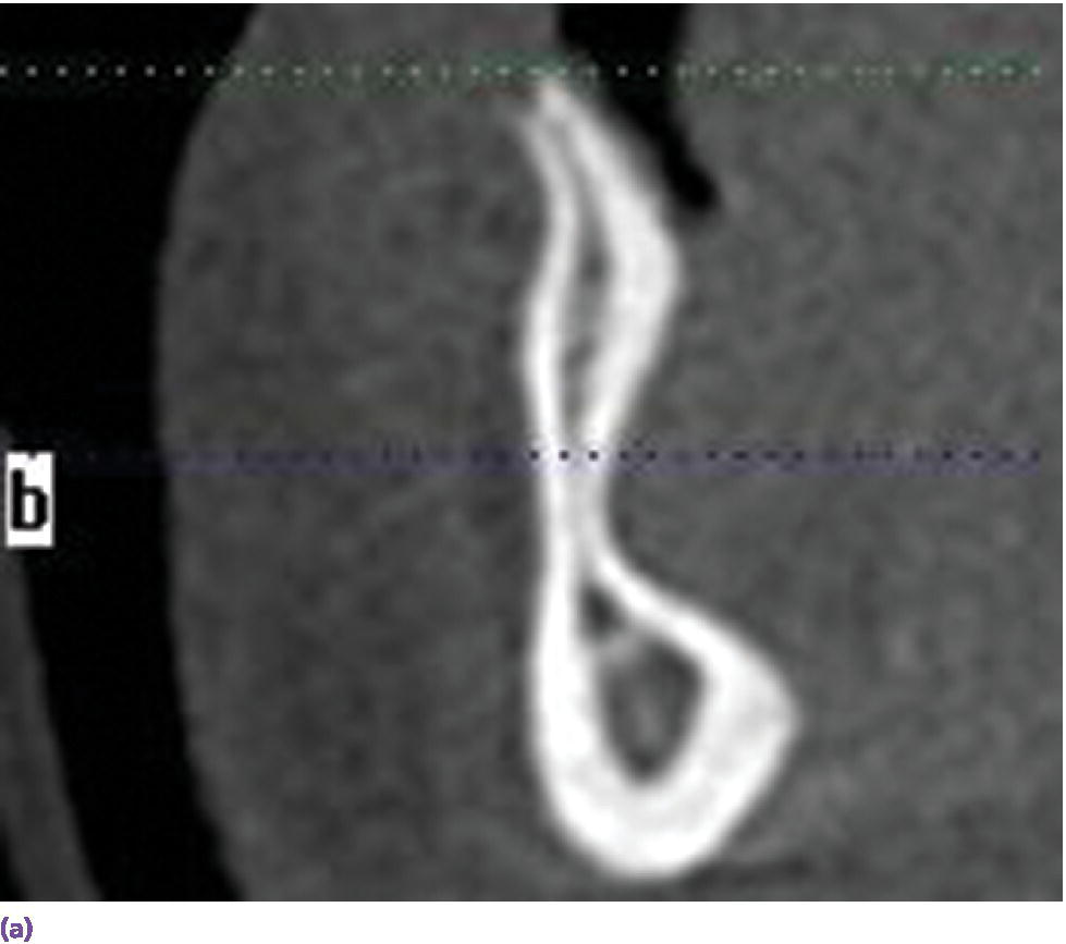 CBCT scan displaying hourglass morphology of anterior mandibular bone.