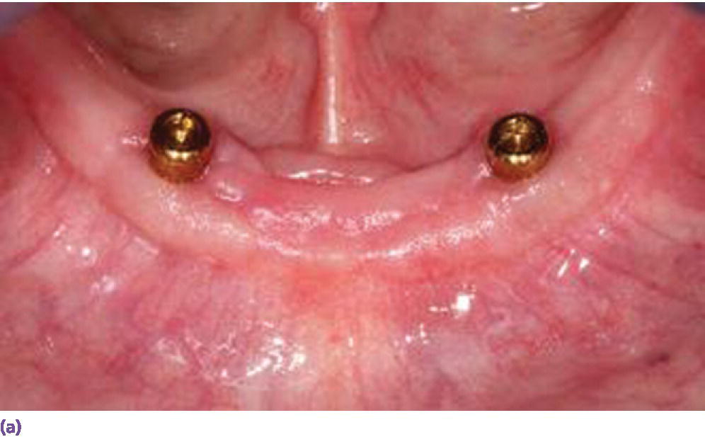 Photo displaying u-shaped arch restored with two solitary anchors which may demonstrate anterior–posterior rotation on incisal biting.