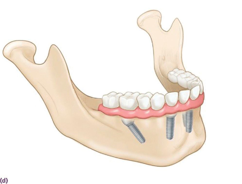 Graphic illustrating the extended occlusal table and reduced cantilever afforded by tilted terminal implants.