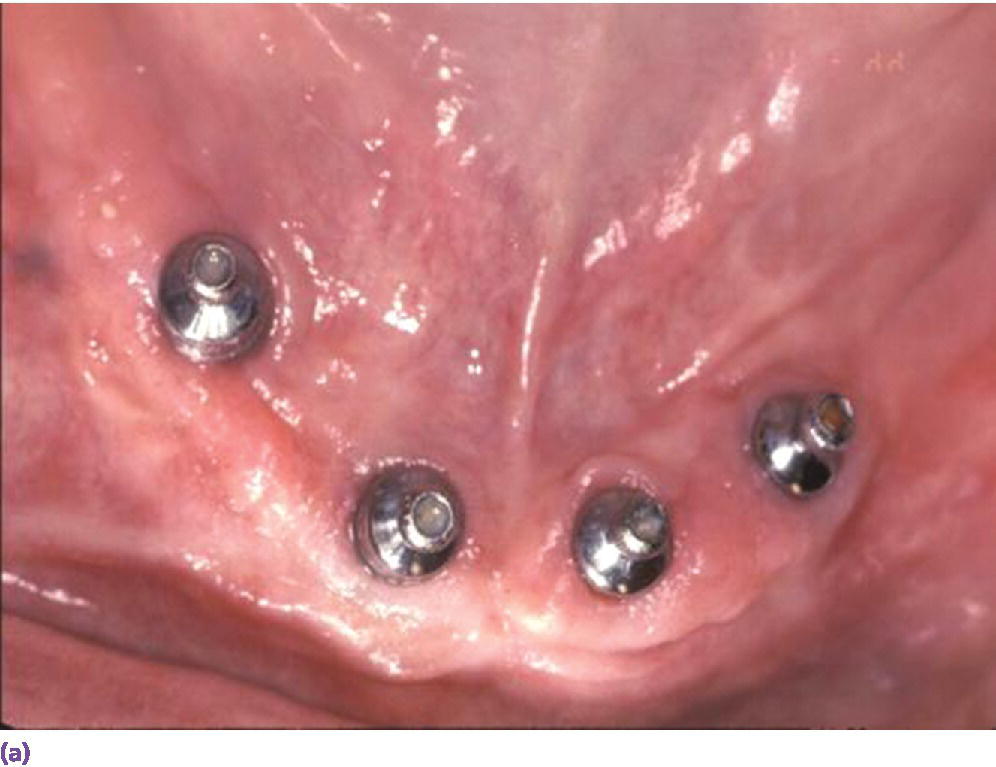 Photo displaying multiple implants placed in edentulous mandible opposing a natural dentition.