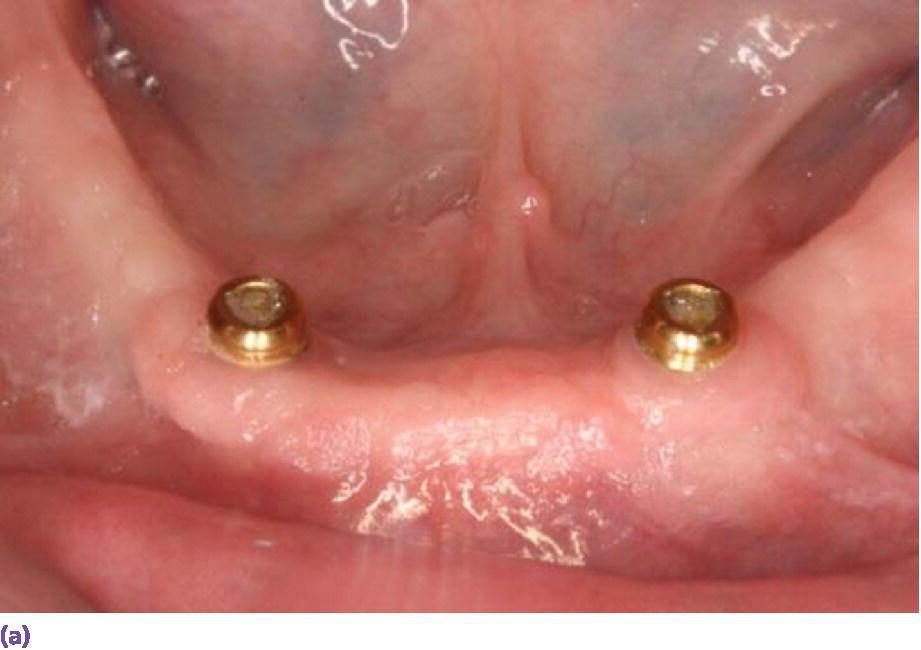 Photo displaying LocatorR anchorage system requiring 8–9 mm of interarch space from crest of soft tissue to opposing dentition.