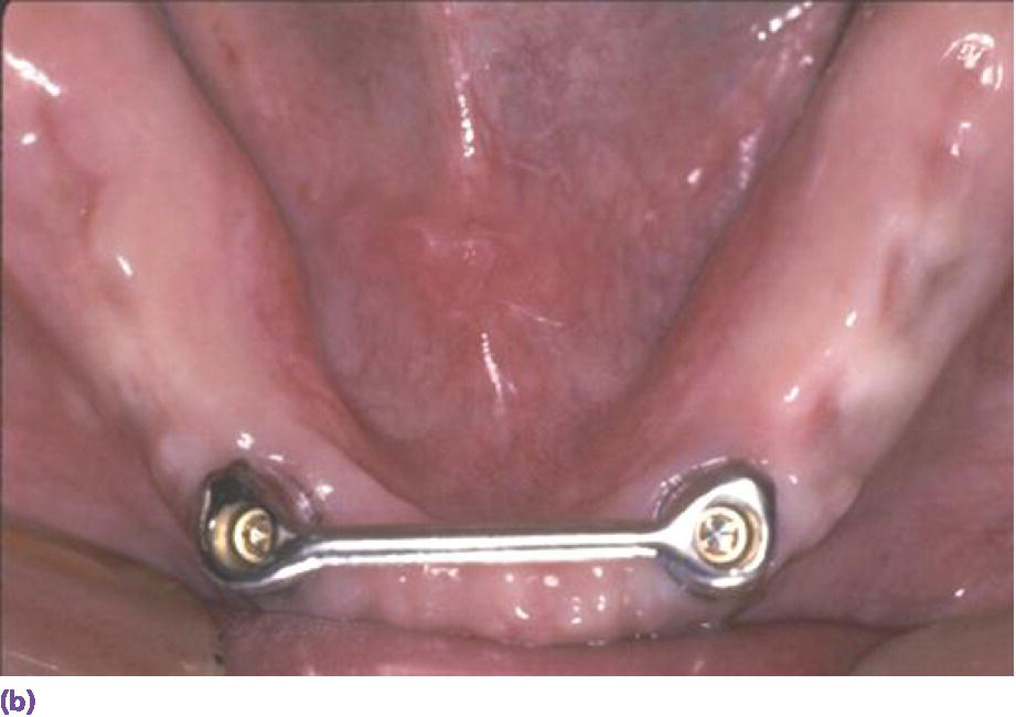 Photo displaying Dolder bar anchorage system requiring 12 mm of interarch space from crest of soft tissue to opposing dentition.