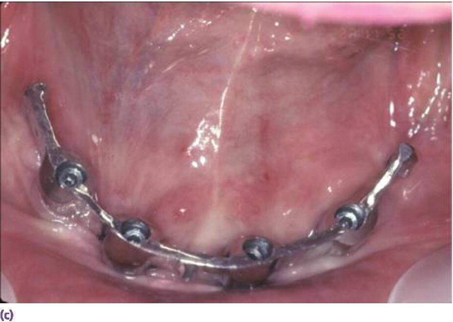 Photo displaying spark-eroded 2-degree milled bar anchorage system requiring 11 mm of interarch space from crest of soft tissue to opposing dentition.